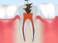 重度の虫歯は根管治療